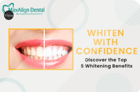 Top 5 Benefits of Professional Teeth Whitening