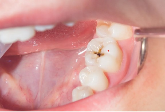 Teeth Whitening