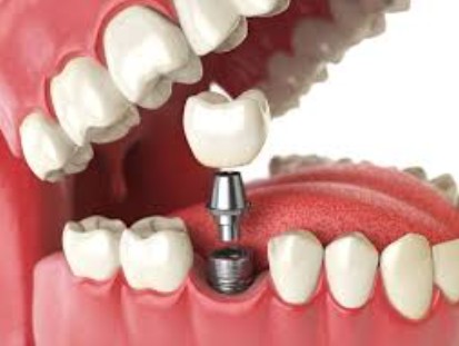 Dental Implants